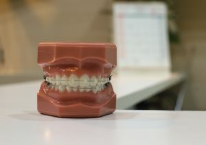 De ce să alegi un aparat dentar din safir